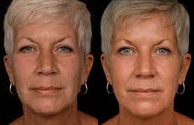A woman's face before and after